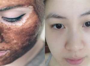 Bỏ túi ngay 8 cách tẩy tế bào chết cho da nhờn mụn siêu hiệu quả